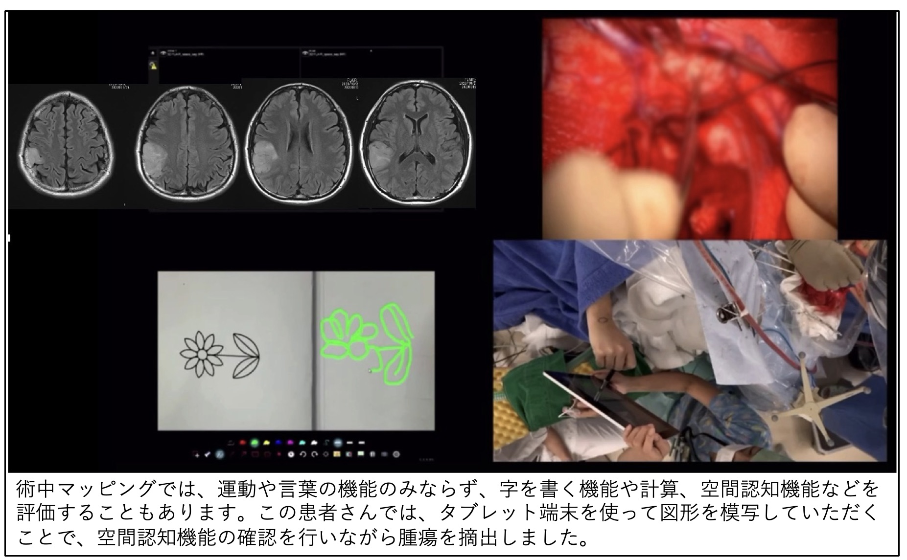 覚醒下手術 | 特色ある治療 | 東京慈恵会医科大学附属病院 脳神経外科